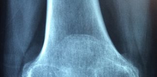 Dieta przy reumatoidalnym zapaleniu stawów