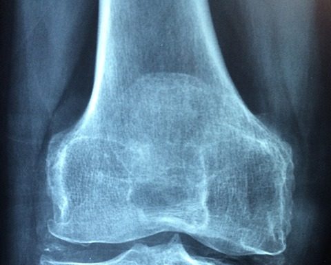 Dieta przy reumatoidalnym zapaleniu stawów Dieta przy reumatoidalnym zapaleniu stawów